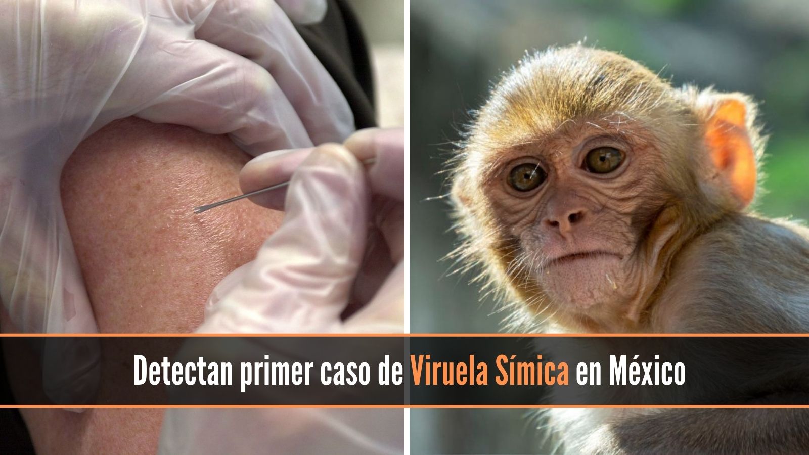 Primer caso de viruela del mono en méxico Viruela Símica