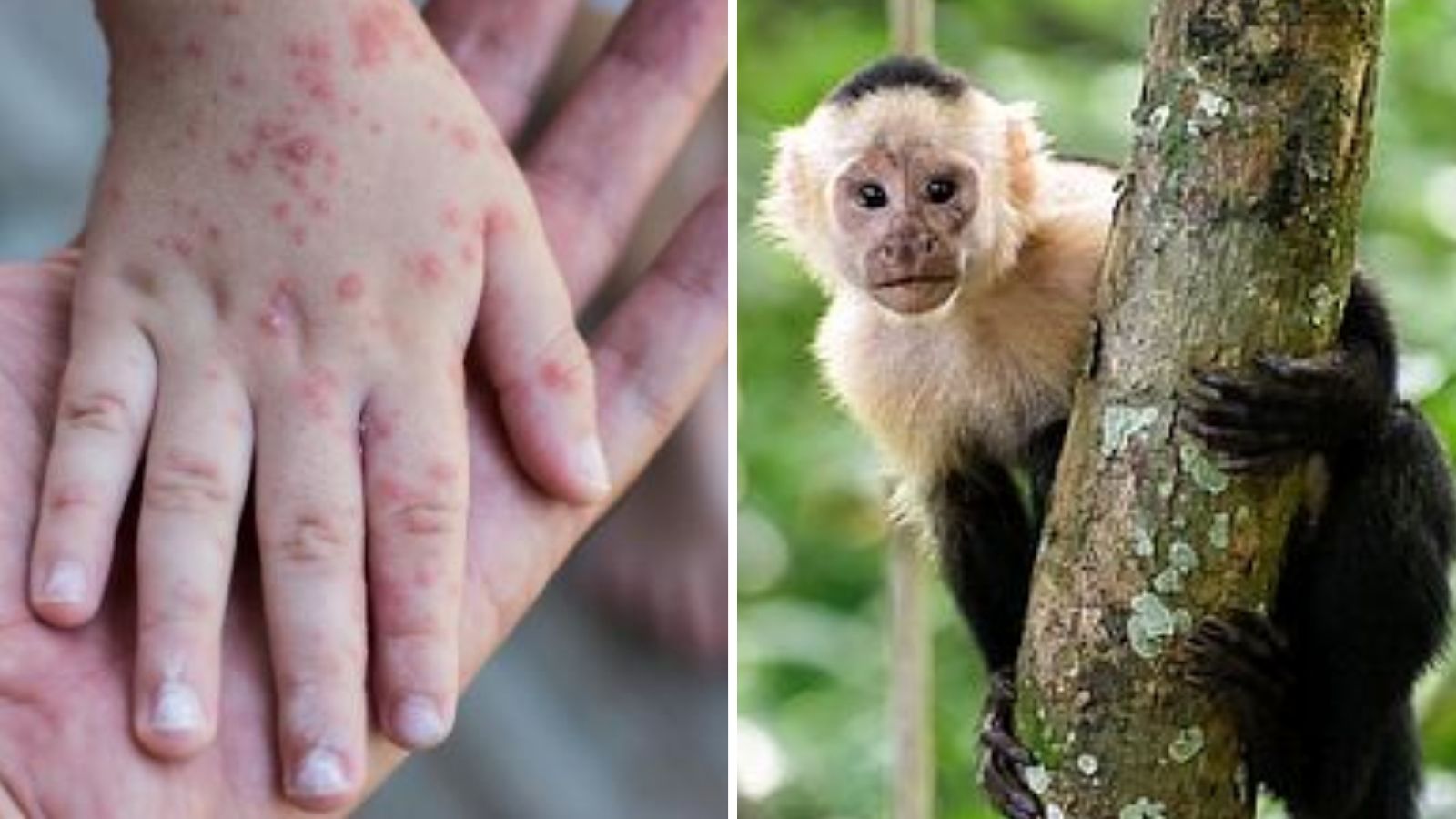 Viruela del mono aumenta en México