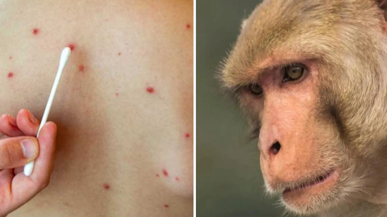suman 386 casos de viruela del mono en México