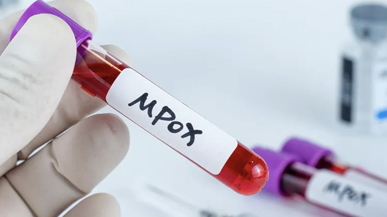 Viruela símica o del mono mpox en México